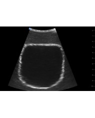 Trainer per ecografica della vescica SonoEZ