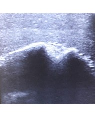 Simulatore per l ecografia dell articolazione della spalla SonoEZ