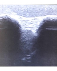 Simulatore per l ecografia dell articolazione della spalla SonoEZ