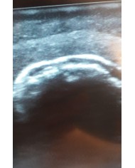 Simulatore per l ecografia dell articolazione della spalla SonoEZ