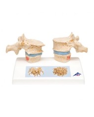 3B Scientific, Modello di osteoporosi A95