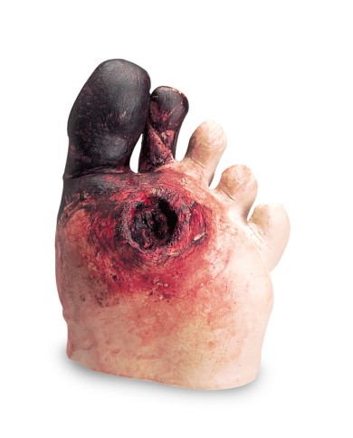 Piede diabetico Erler Zimmer R10027