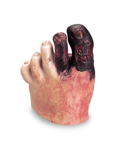 Piede diabetico Erler Zimmer R10027