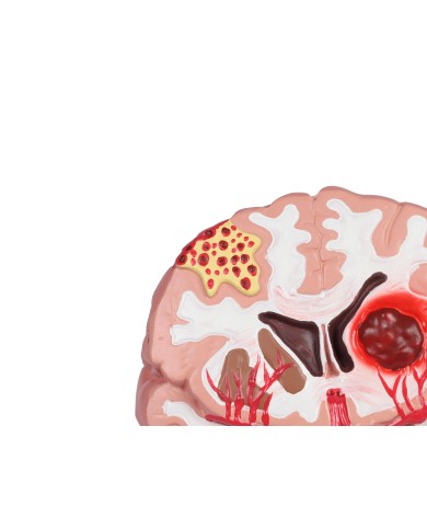 Patologie del cervello umano Erler Zimmer C711 Patologie del cervello umano Erler Zimmer C711