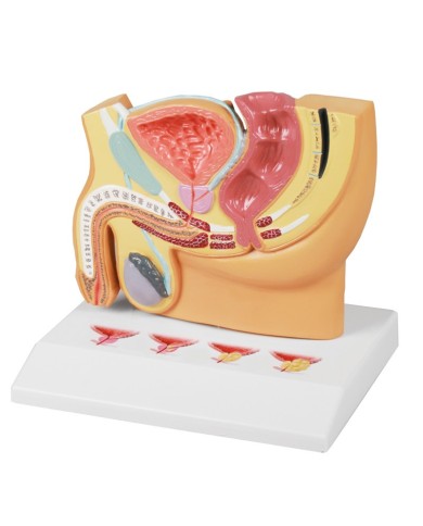 Sezione della pelvi maschile con malattia della prostata Erler Zimmer H224 Sezione della pelvi maschile con malattia della prostata Erler Zimmer H224