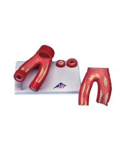 3B Scientific, Modello di arteriosclerosi, con sezione delle arterie, scomponibile in 2 parti G40 3B Scientific, Modello di arteriosclerosi, con sezione delle arterie, scomponibile in 2 parti G40