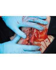 Moulage e simulazione di ampia lacerazione con lacerazioni minori con funzi