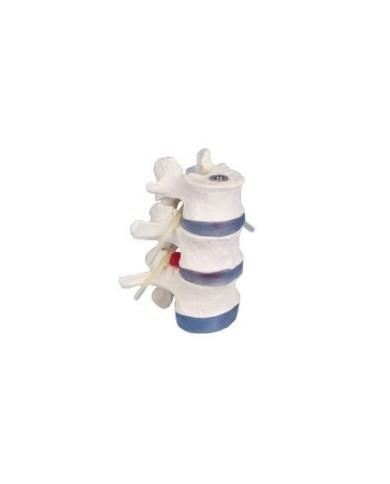 Erler Zimmer modello anatomico didattico di 3 vertebre lombari con prolasso 4048 Erler Zimmer modello anatomico didattico di 3 vertebre lombari con prolasso 4048
