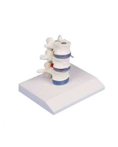Erler Zimmer modello anatomico didattico di 3 vertebre lombari con prolasso, su stand 4047 Erler Zimmer modello anatomico didattico di 3 vertebre lombari con prolasso, su stand 4047