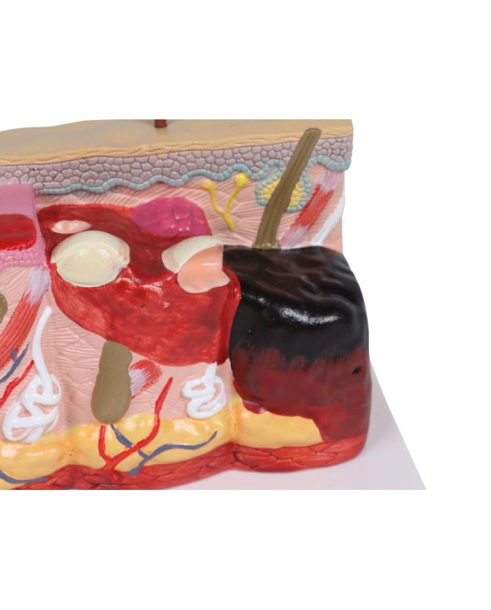 Modello di pelle patologica con ustioni ingrandita 30 volte Erler Zimmer E