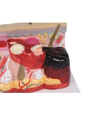 Modello di pelle patologica con ustioni ingrandita 30 volte Erler Zimmer E