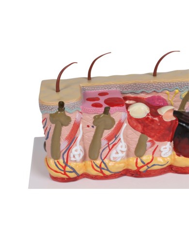 Modello di pelle patologica con ustioni ingrandita 30 volte Erler Zimmer E Modello di pelle patologica con ustioni ingrandita 30 volte Erler Zimmer E