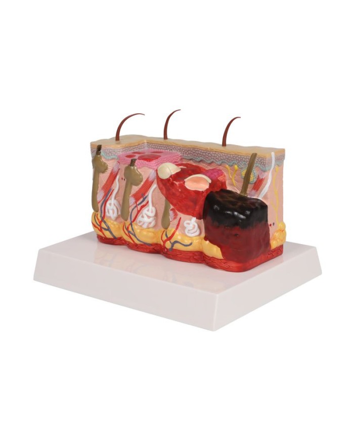 Modello di pelle patologica con ustioni ingrandita 30 volte Erler Zimmer E