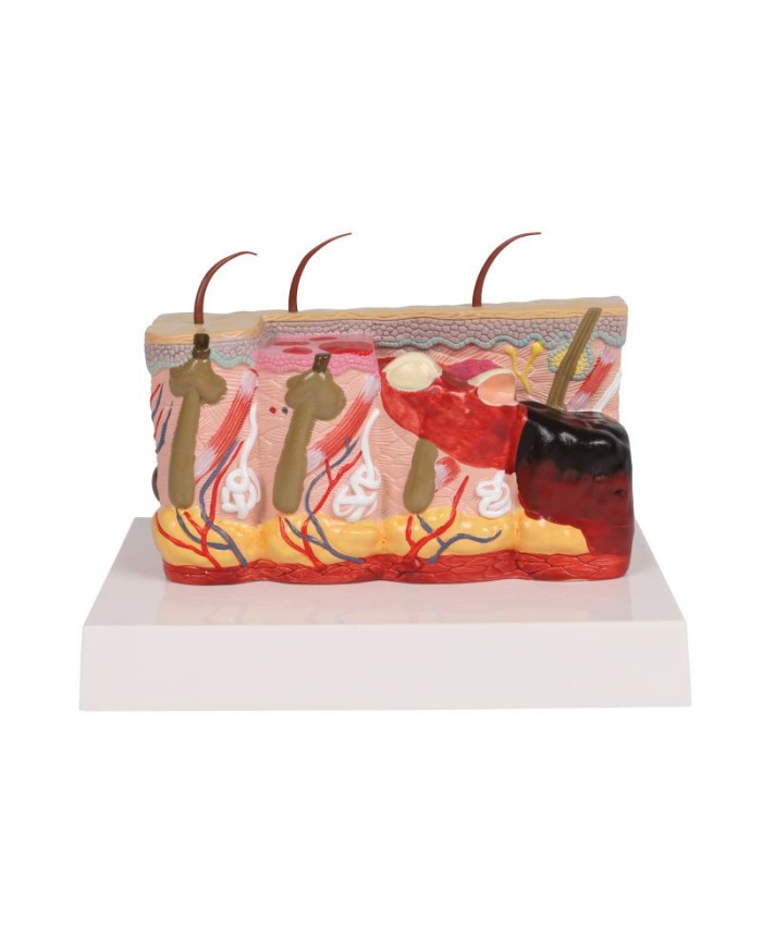 Modello di pelle patologica con ustioni ingrandita 30 volte Erler Zimmer E