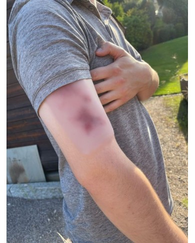 Moulage di Ferita Ematoma Fresco Erler Zimmer EZ NW117