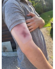 Moulage di Ferita Ematoma Fresco Erler Zimmer EZ NW117