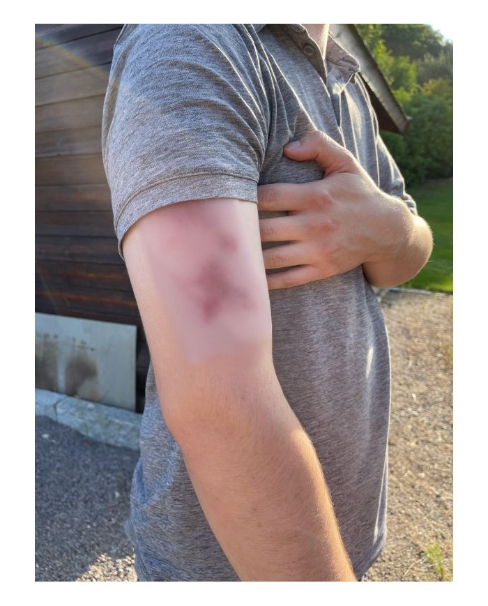 Moulage di Ferita Ematoma Fresco Erler Zimmer EZ NW117