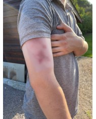 Moulage di Ferita Ematoma Fresco Erler Zimmer EZ NW117