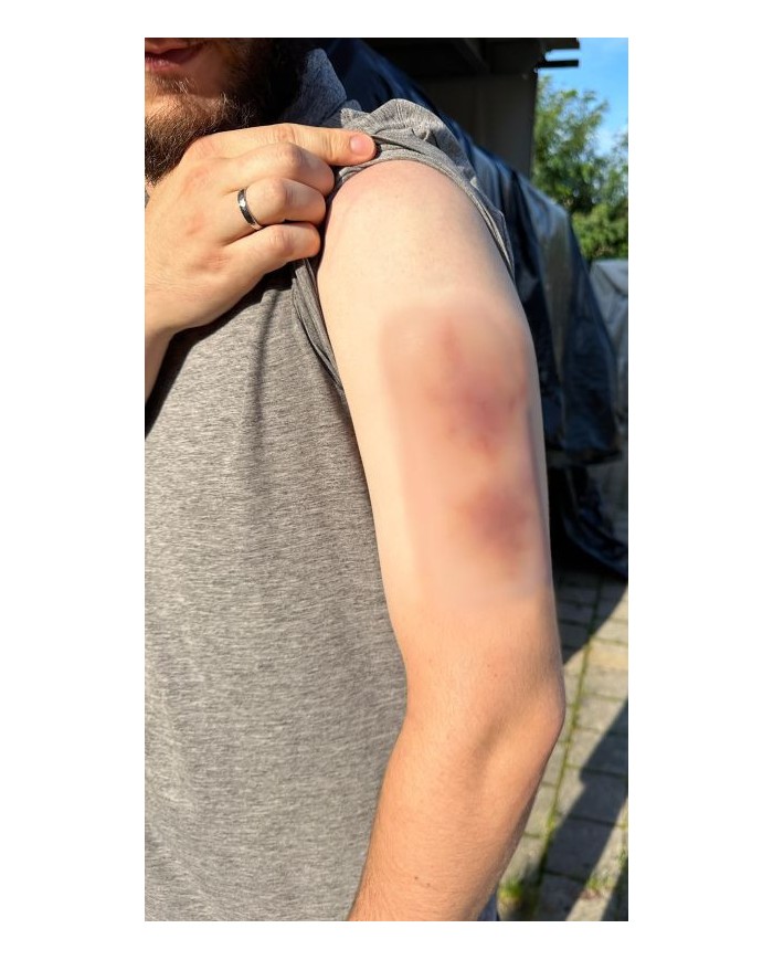 Moulage di Ferita Ematoma Vecchio EZ NW119