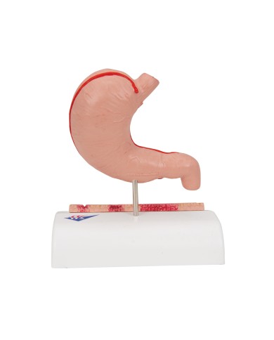 Modello anatomico di Stomaco con ulcere gastriche 3B Scientific K17