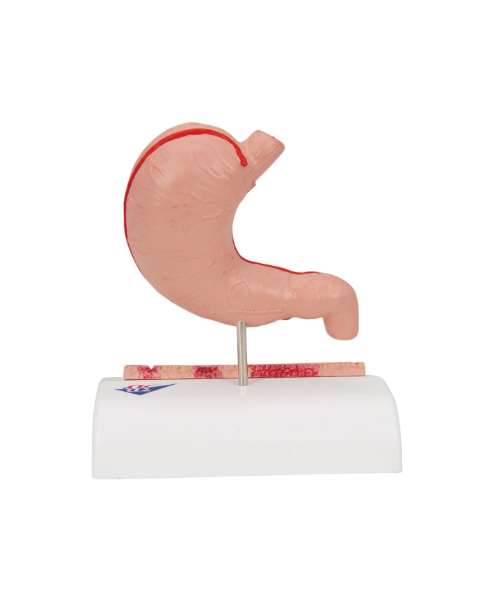 Modello anatomico di Stomaco con ulcere gastriche 3B Scientific K17