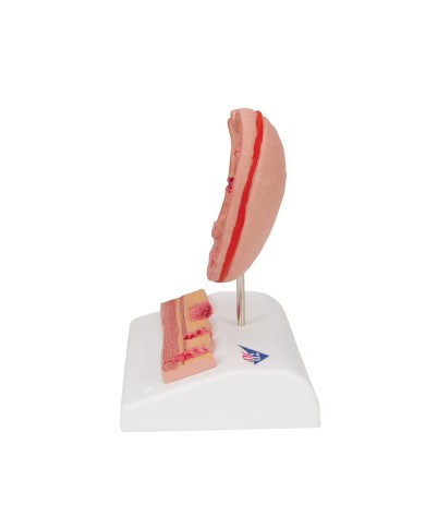 Modello anatomico di Stomaco con ulcere gastriche 3B Scientific K17