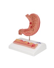 Modello anatomico di Stomaco con ulcere gastriche 3B Scientific K17