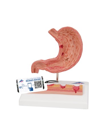 Modello anatomico di Stomaco con ulcere gastriche 3B Scientific K17 Modello anatomico di Stomaco con ulcere gastriche 3B Scientific K17