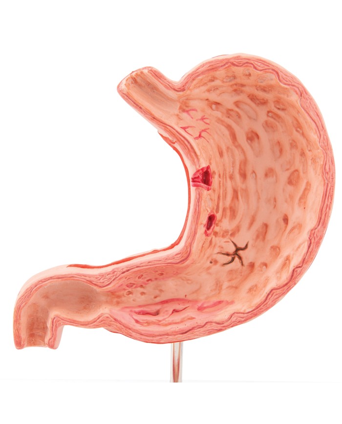 Modello anatomico di Stomaco con ulcere gastriche 3B Scientific K17
