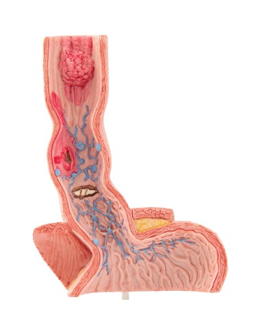 Modello anatomico di Malattie dell esofago 3B Scientific K18 Modello anatomico di Malattie dell esofago 3B Scientific K18