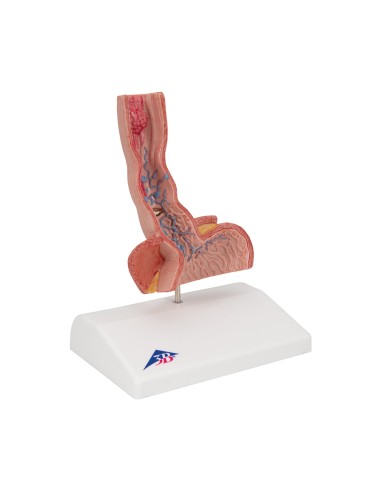 Modello anatomico di Malattie dell esofago 3B Scientific K18 Modello anatomico di Malattie dell esofago 3B Scientific K18