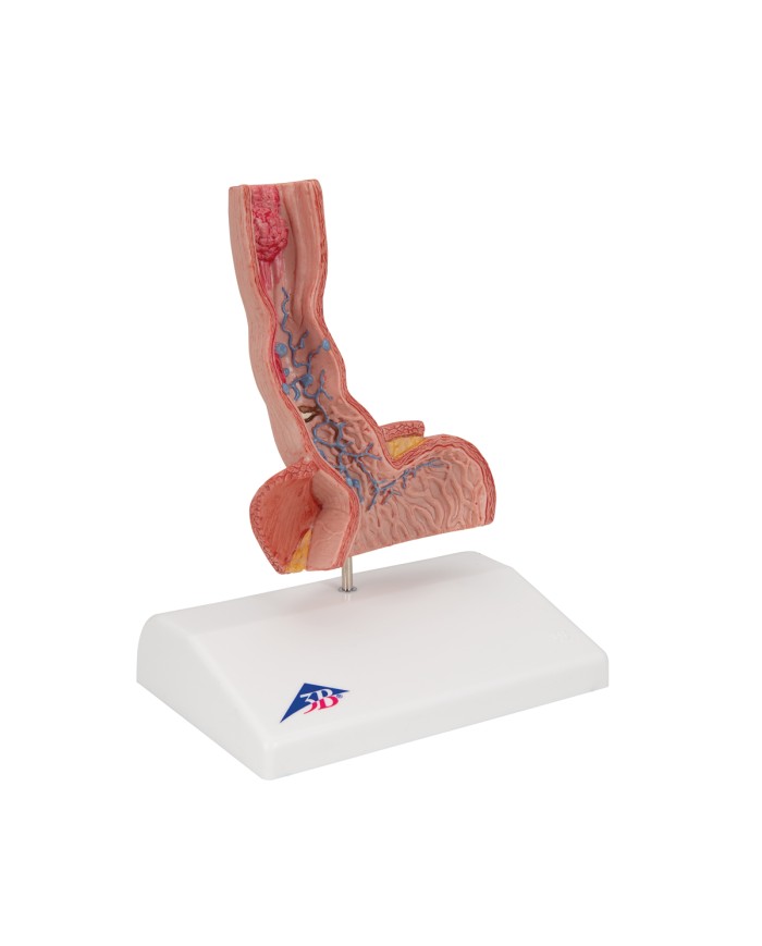 Modello anatomico di Malattie dell esofago 3B Scientific K18