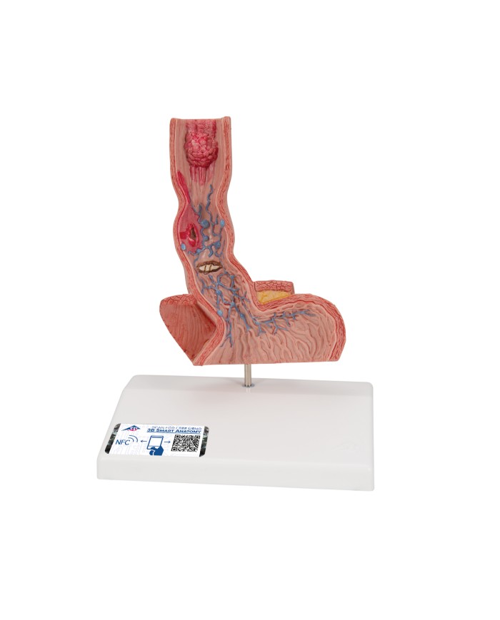 Modello anatomico di Malattie dell esofago 3B Scientific K18