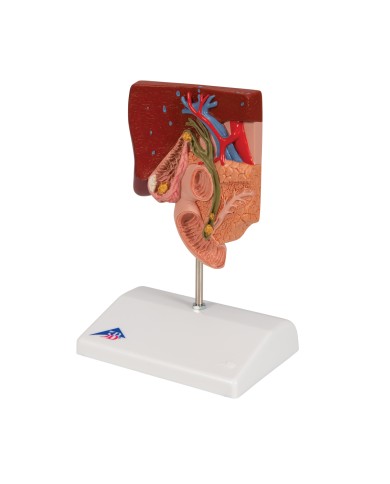 Modello anatomico di Calcoli biliari 3B Scientific K26 Modello anatomico di Calcoli biliari 3B Scientific K26