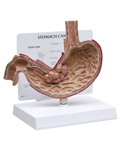 Modello di cancro allo stomaco 3B Scientific 1019524 Modello di cancro allo stomaco 3B Scientific 1019524