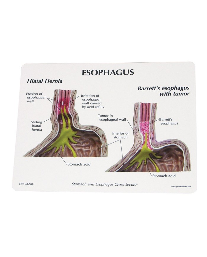 Modello di Reflusso Gastro esofageo 3B Scientific 1019525