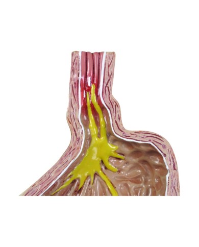 Modello di Reflusso Gastro esofageo 3B Scientific 1019525 Modello di Reflusso Gastro esofageo 3B Scientific 1019525