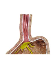 Modello di Reflusso Gastro esofageo 3B Scientific 1019525