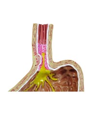 Modello di Reflusso Gastro esofageo 3B Scientific 1019525