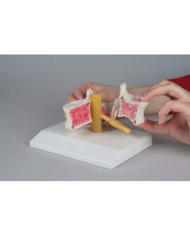 Erler Zimmer, modello anatomico di vertebra con osteoporosi