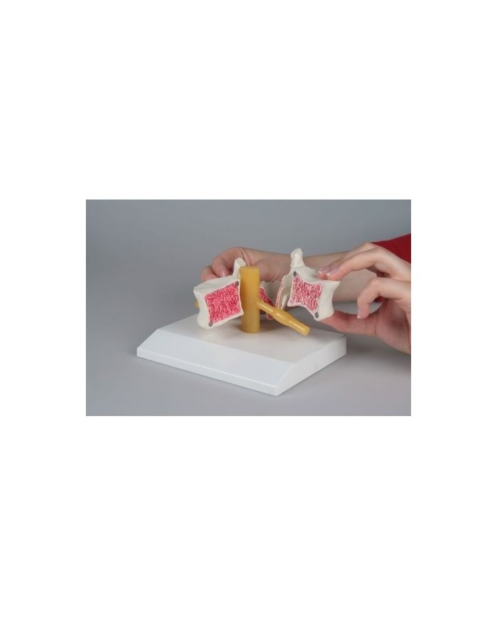 Erler Zimmer, modello anatomico di vertebra con osteoporosi