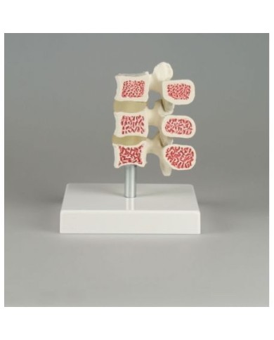 Erler ZImmer, modello anatomico di osteoporosi, a grandezza naturale, su base 4078