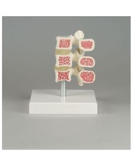 Erler ZImmer, modello anatomico di osteoporosi, a grandezza naturale, su base 4078