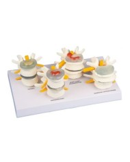 Erler Zimmer, modello anatomico di patologie del disco intervertebrale 7576