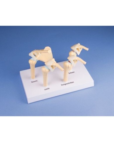 Erler Zimmer, modello anatomico di 4 stadi dell'osteoartrite della spalla