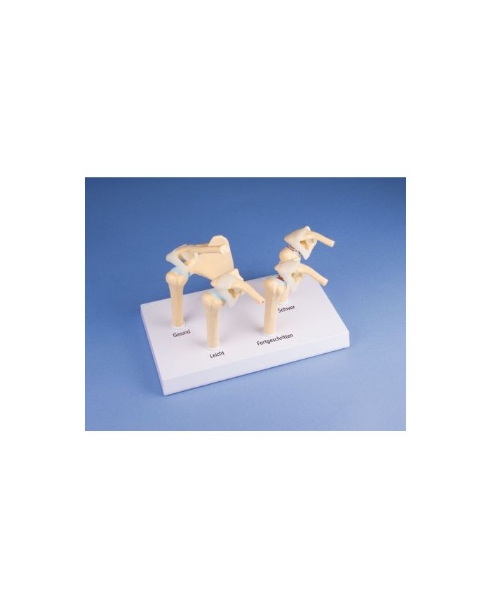 Erler Zimmer, modello anatomico di 4 stadi dell'osteoartrite della spalla