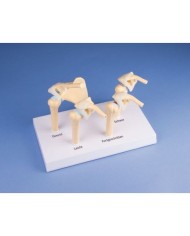 Erler Zimmer, modello anatomico di 4 stadi dell'osteoartrite della spalla