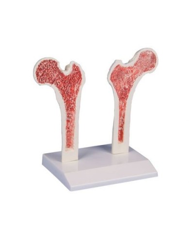 Erler Zimmer, modello anatomico di femore con osteoporosi Erler Zimmer, modello anatomico di femore con osteoporosi