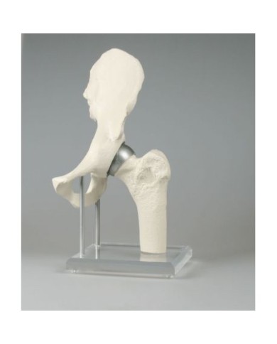 Erler Zimmer, modello anatomico di articolazione dell'anca, con protesi Birmingham 1118