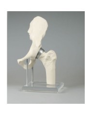 Erler Zimmer, modello anatomico di articolazione dell'anca, con protesi Birmingham 1118